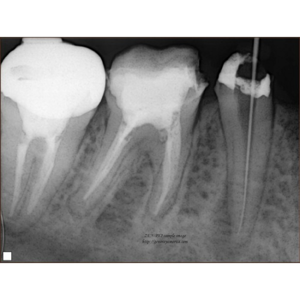 Genoray PORT-X II - портативный высокочастотный интраоральный рентгеновский аппарат